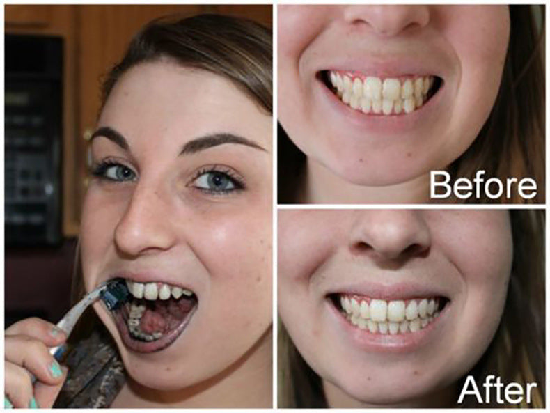 New Charcoal Teeth Whitning and Gum Detoxifying System